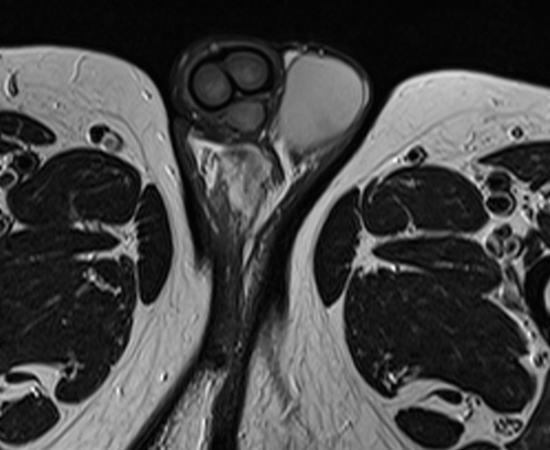 MRI testis axial t2 high resolution images(mri of testicles)