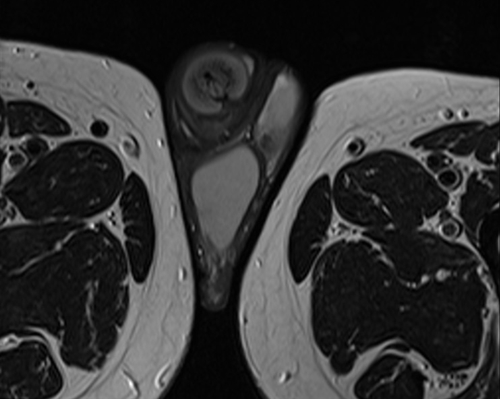 MRI testis axial t2 high resolution images(mri of testicles)