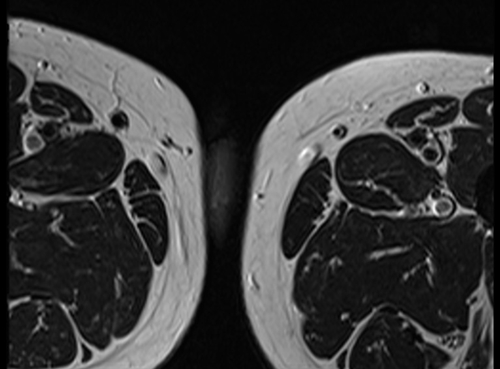 MRI testis axial t2 high resolution images(mri of testicles)