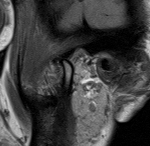 mri temporomandibular joints  pd sagittal open mouth images