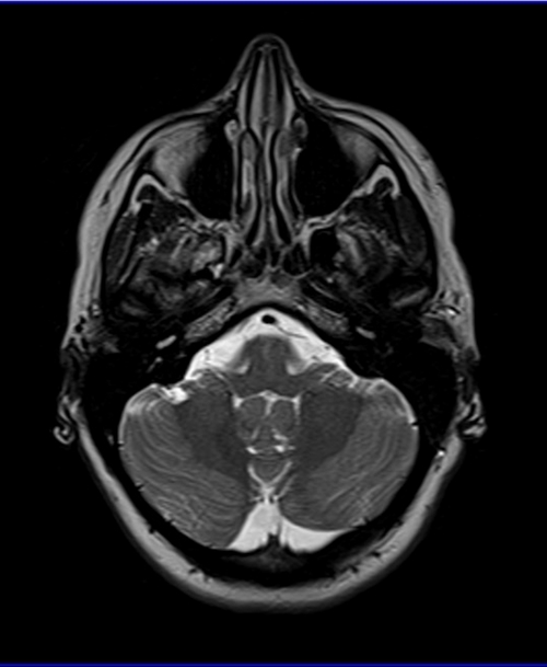 mri temporomandibular joints axial t2 images