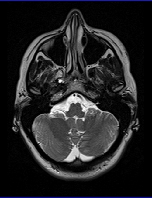 mri temporomandibular joints axial t2 images