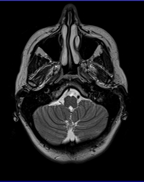 mri temporomandibular joints axial t2 images