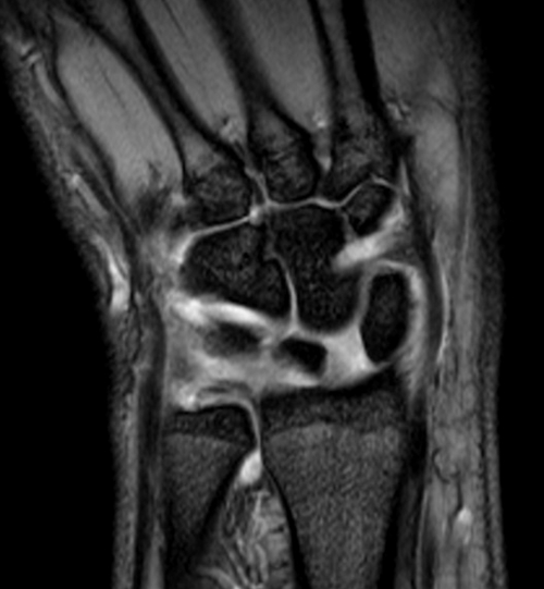 wrist mri coronal medic(T2*) image