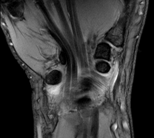 wrist mri coronal medic(T2*) image