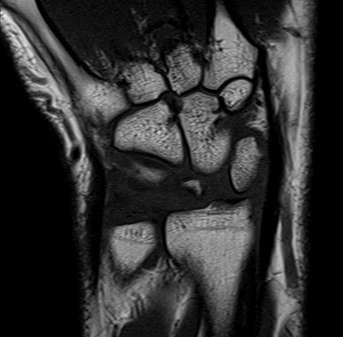 wrist mri coronal t1 image