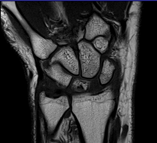 wrist mri coronal t1 image