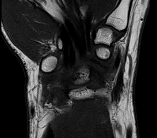 wrist mri coronal t1 image