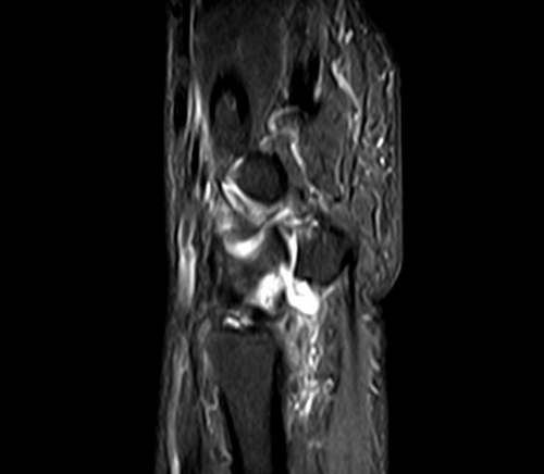 MRI wrist sagittal stir image