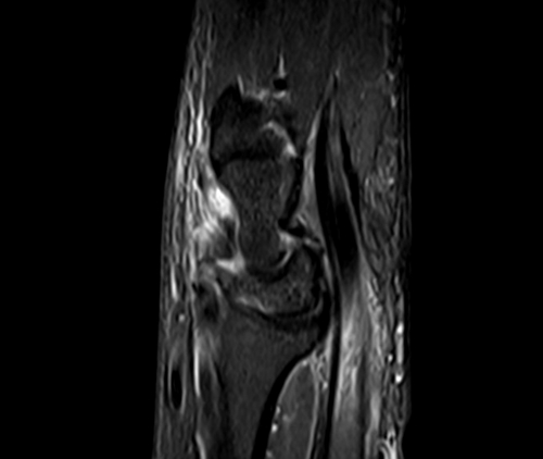 MRI wrist sagittal stir image