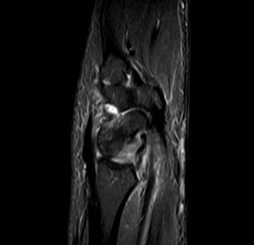 MRI wrist sagittal stir image