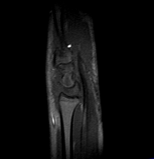 wrist mri localizer image