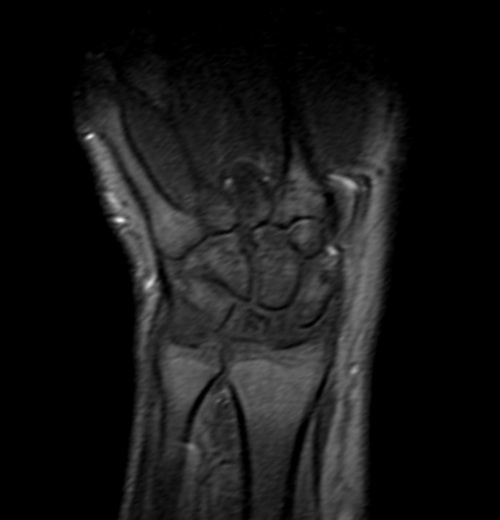 wrist mri localizer image