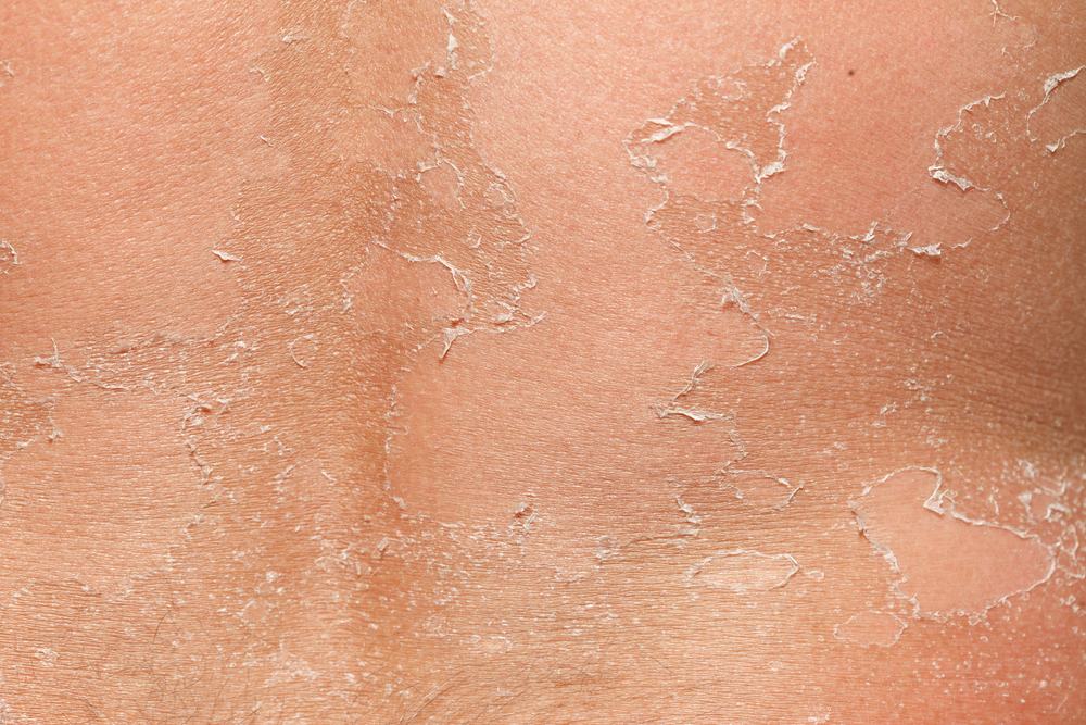 peeling skin