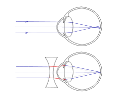 Schematisch oog bijziend
