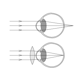 schematisch oog verziend