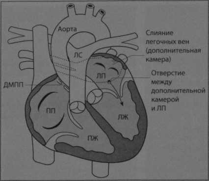 Снимки МРТ и КТ. Трехпредсердное сердце
