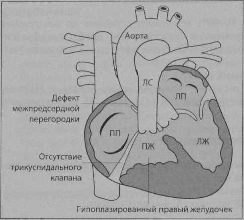 Снимки МРТ и КТ. Атрезия трикуспидального клапана