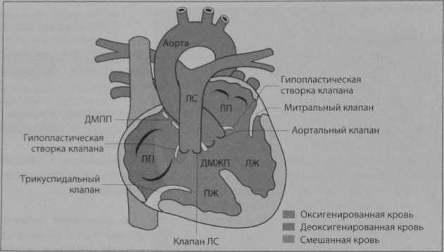 Снимки МРТ и КТ. Дефект атриовентрикулярной перегородки