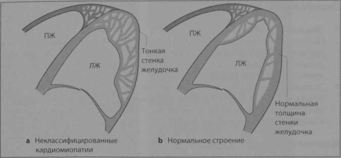 Снимки МРТ и КТ. Неклассифицированные кардиомиопатии