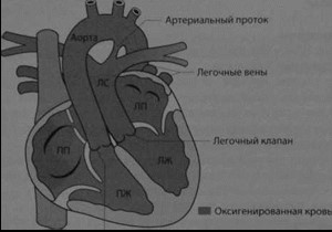 Снимки МРТ и КТ. Транспозиция крупных артерий (декстротранспозиция)
