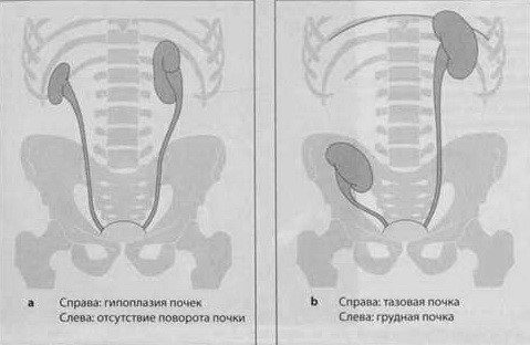 Снимки МРТ и КТ. Пороки развития почек