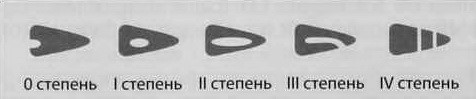 Снимки МРТ и КТ. Повреждения менисков
