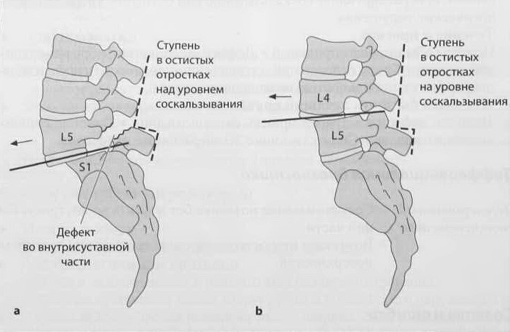 Снимки МРТ и КТ. Спондилез/ спондилолистез