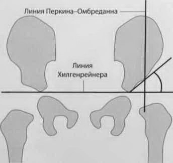 Снимки МРТ и КТ. Дисплазия тазобедренного сустава