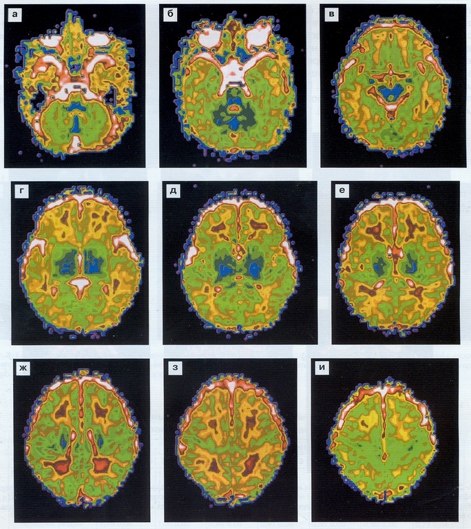 Спектроскопия МРТ