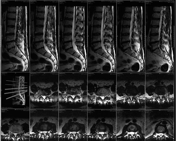 МРТ снимок позвоночника