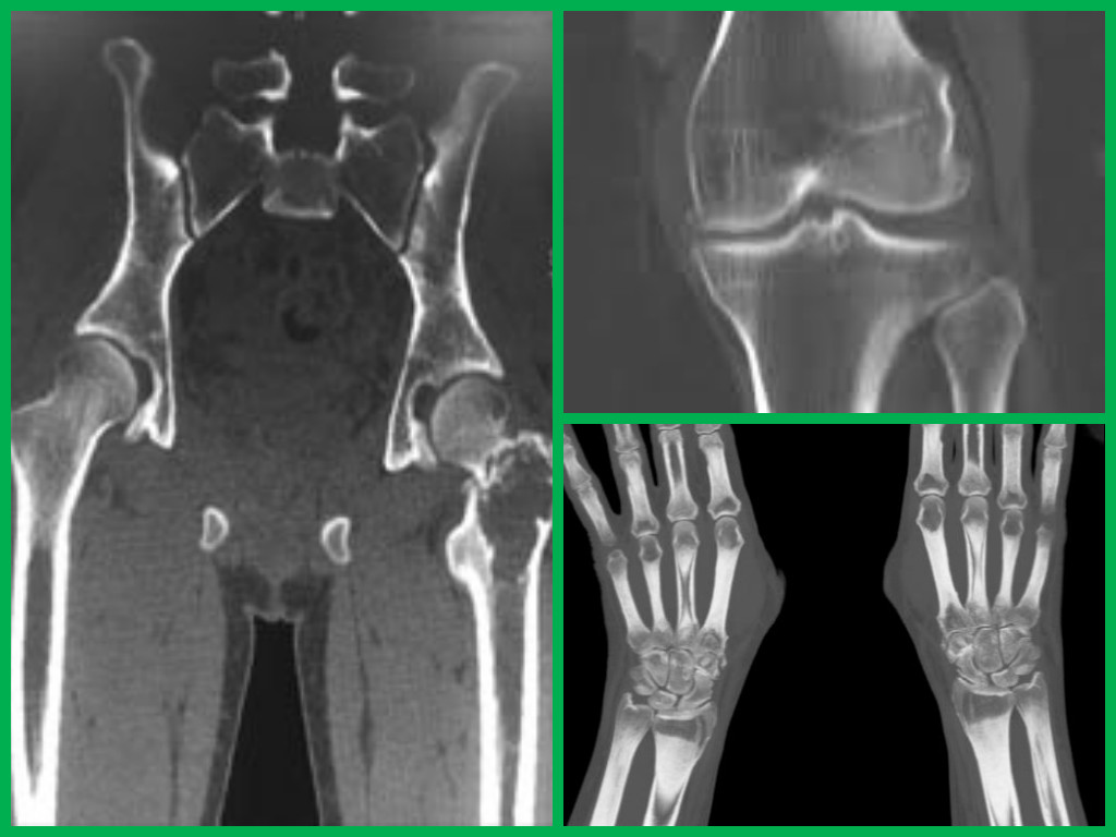 КТ суставов, коленный, локтевой, лучезапястный