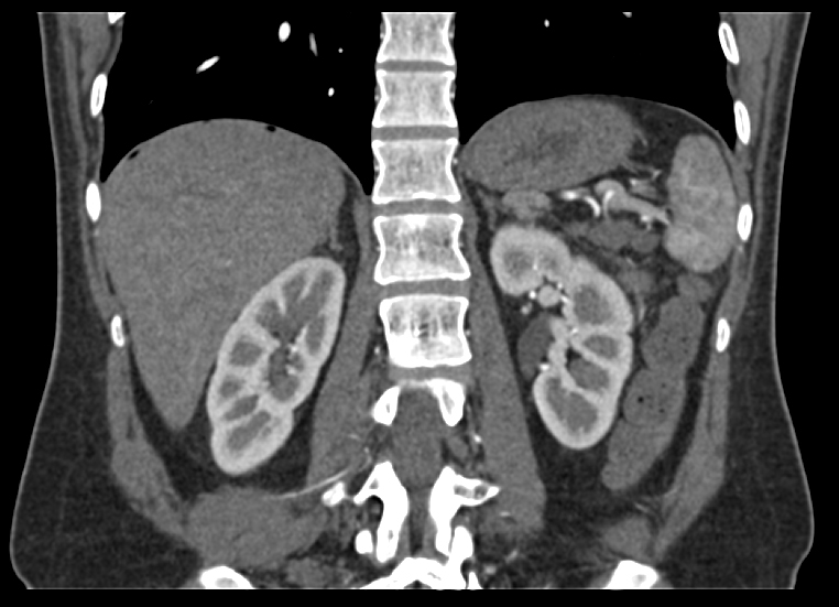 КТ брюшной полости, что показывает