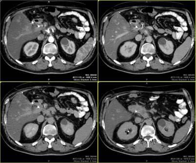 КТ органов брюшной полости фото