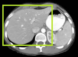 КТ печени, что показывает