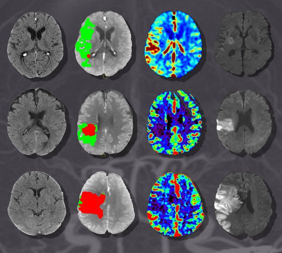 КТ ангиография мозга и шеи