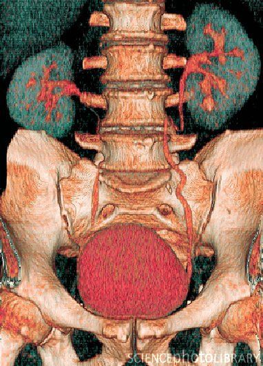 КТ мочевого пузыря