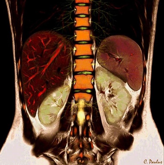 Томография брюшной полости