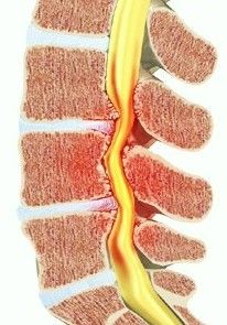 КТ миелография