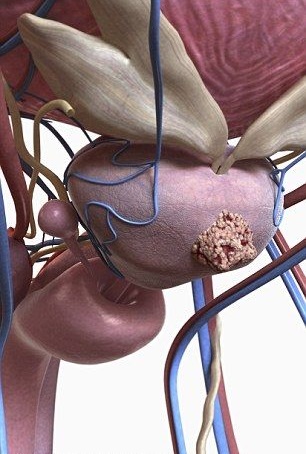 КТ малого таза