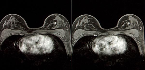 КТ молочных желез