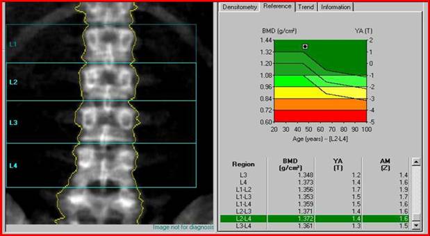 Денситометрия