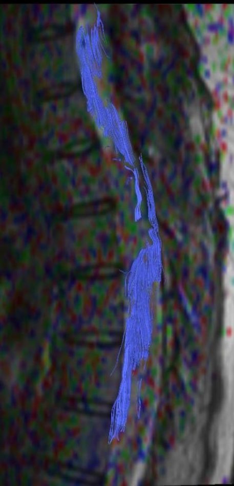 Трактография спинного мозга