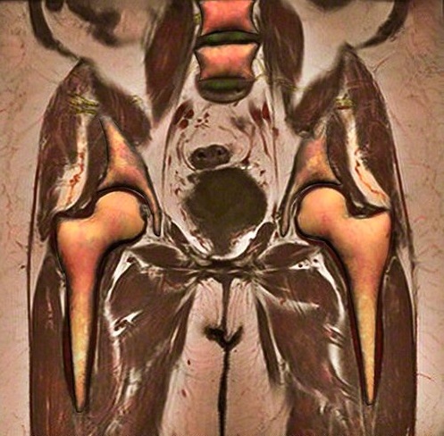 МРТ тазобедренных суставов