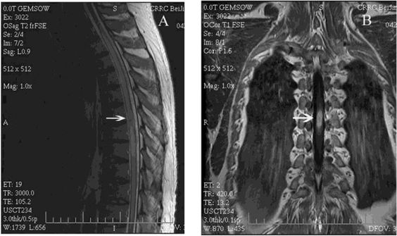 МРТ грудного отдела
