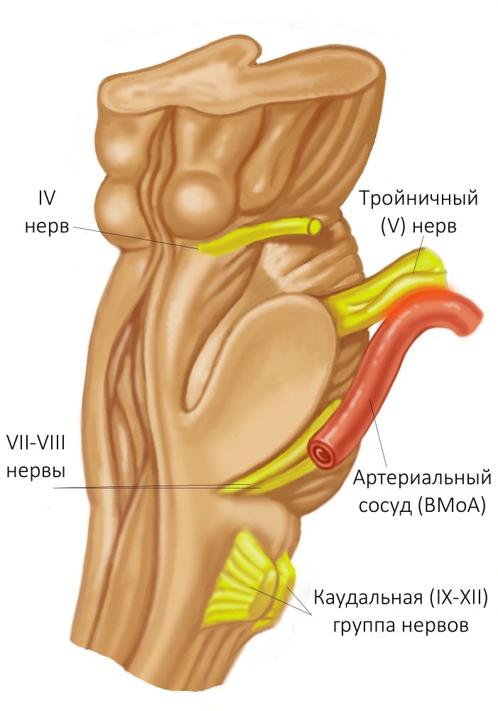 Снимки МРТ и КТ. Синдромы сосудистой компрессии