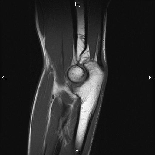 МРТ локтевого сустава, что показывает, где сделать
