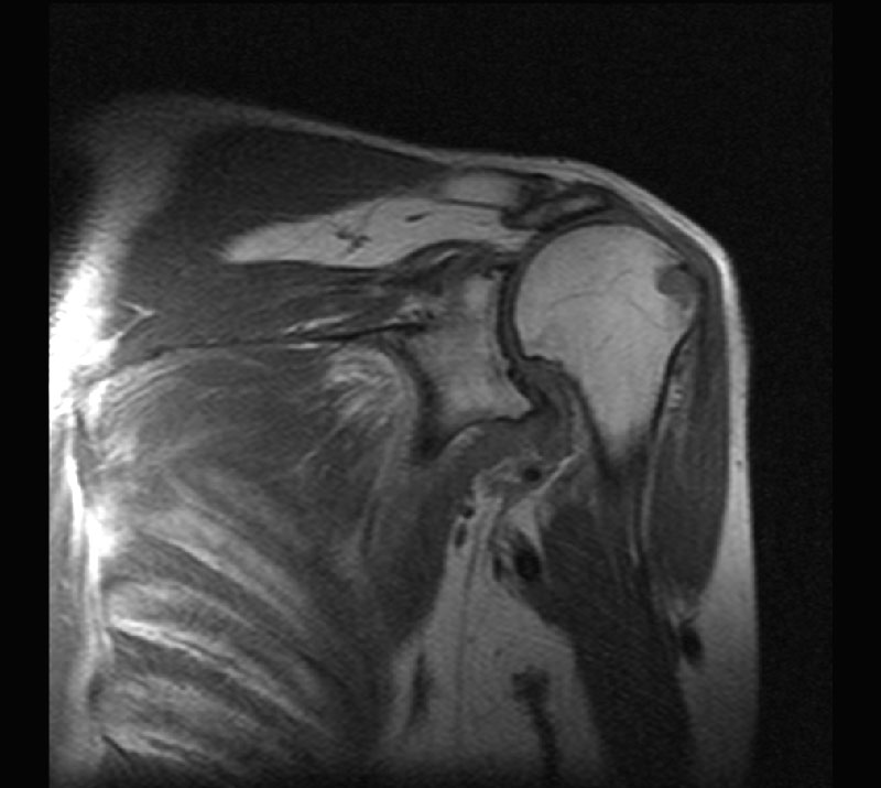 МРТ плечевого сустава