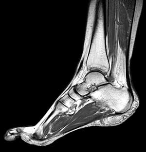 МРТ голеностопного сустава
