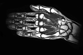 МРТ лучезапястного сустава